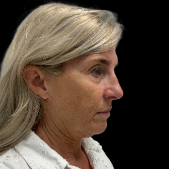 deepplane-facelift-before